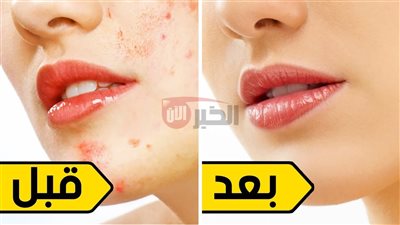 طرق فعالة لتقليل البقع الداكنة وآثار الحبوب.. روتين بسيط لبشرة صافية ومشرقة