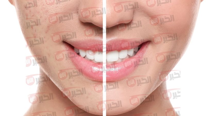 إزالة آثار الحبوب