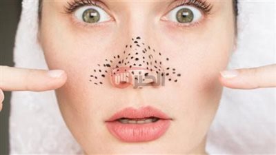 أفضل ماسكات طبيعية لإزالة الرؤوس السوداء وتنقية البشرة بعمق